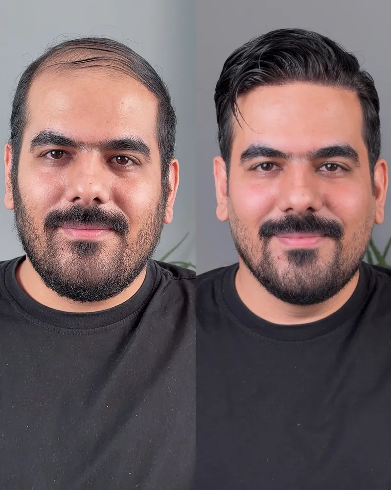 پروتز مو هالیوودی
