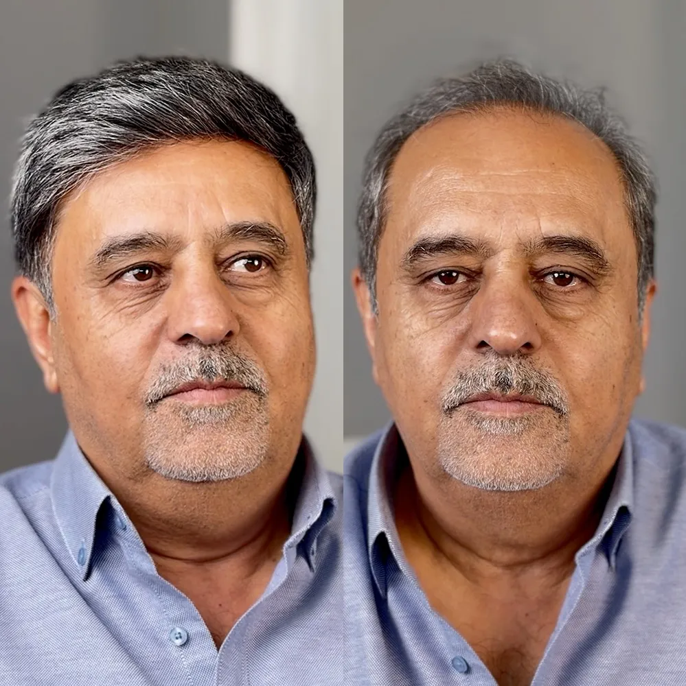 پروتز مو نیوزلندی،نصب کلیپسی