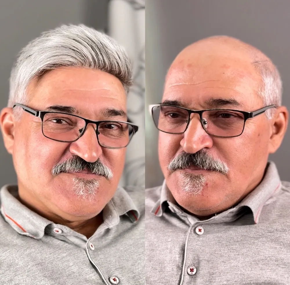 قبل و بعد 80 درصد سفیدی